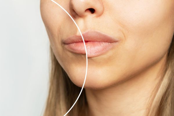 עיבוי שפתיים בגלי רדיו לפני ואחרי